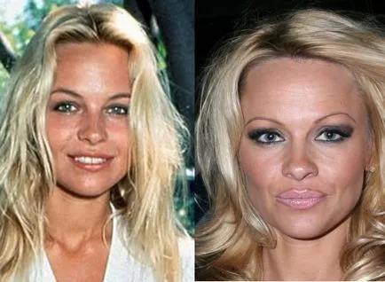 Памела Андерсън преди и след операцията (снимки) - 300