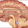 Perinatális encephalopathia gyermekek és következményei a felnőtt életben