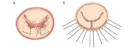 Пластмасови митралната клапа - указания и техника на