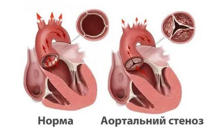 Пластмасови митралната клапа - указания и техника на