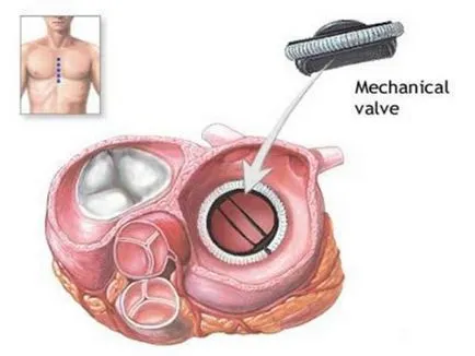 valva mitrală din material plastic - indicații și tehnica