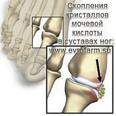 Подагра и подагрозен артрит