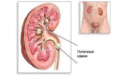 Подагрозен артрит симптоми, лечение, снимки