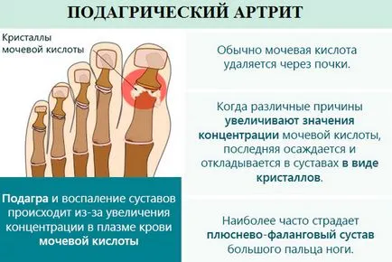 Подагра (подагрозен артрит) лечение народната медицина
