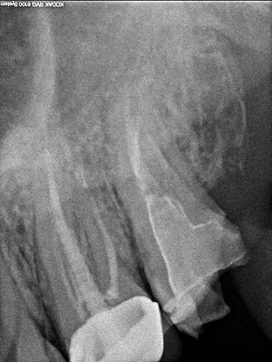 A helyes diagnózis endodoncia