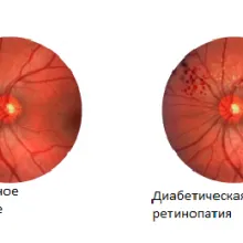 Болки вени на краката, ръцете и главата в какво да правят и как да се лекуват