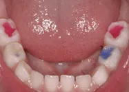 Használata kompomerek gyermekgyógyászati ​​fogászat, klinika „Eurodent”