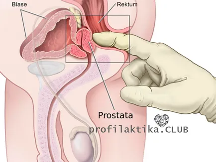 Prevenirea prostatită, simptome și tratament