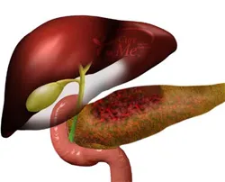 Tratamentul Protocolul de tratament acut etape pancreatită, consecințe, prognosticul