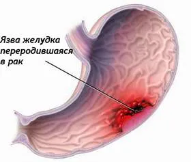 рак на стомаха ранни симптоми за да са наясно с