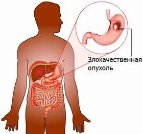 рак на стомаха ранни симптоми за да са наясно с