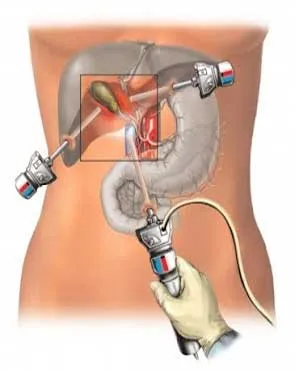 Tratamentul Protocolul de tratament acut etape pancreatită, consecințe, prognosticul