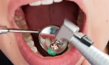 Procesul de instalare a acolade - pregătirea, elemente de prindere pe senzație de dinți în timpul și după