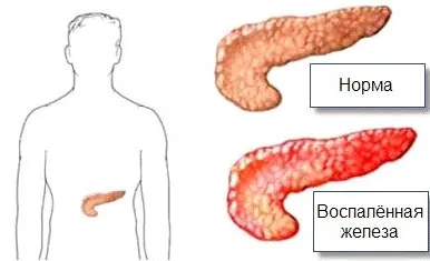 Tratamentul Protocolul de tratament acut etape pancreatită, consecințe, prognosticul