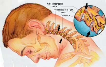 Sciatică, cauze și simptome, tratament si prevenire, medicina populară