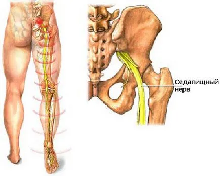 Sciatică, cauze și simptome, tratament si prevenire, medicina populară