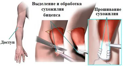 Скъсване на дисталния сухожилие на бицепс (бицепс)