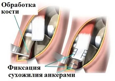 Spargerea tendonul distal al bicepsului (biceps)