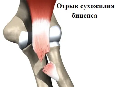 Spargerea tendonul distal al bicepsului (biceps)