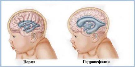 Extinderea ventriculii creierului la adulti inseamna tratament