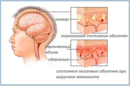 Разширяването на мозъчните вентрикули при възрастни означава третиране