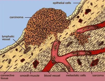 sarcom de țesuturi moi, cauze, diagnostic, prevenire, cum de a determina modul de identificare, prognoză,