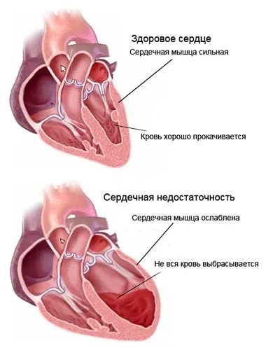 FC insuficienta cardiaca - tratament de inima