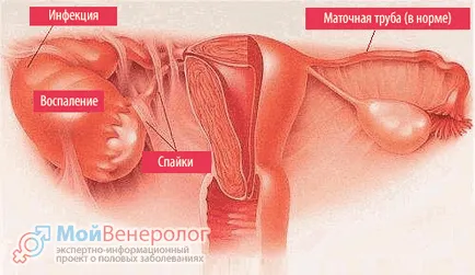 Milyen hosszú a kezelés endometritis