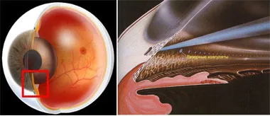 A modern módszerek a glaukóma kezelésére,