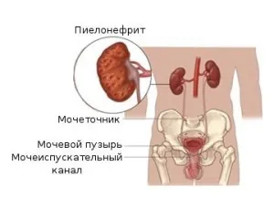 Cât de periculos este nisipul în rinichi și de unde este luat în organism