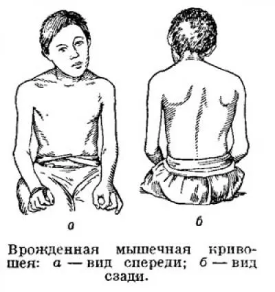 Simptomele distoniei cervicale, cauze si tratament