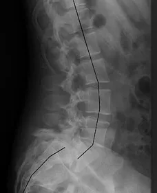 Spinalis stenosis grbnachen Központ