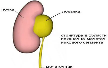 Стеснен уретера - симптоми, лечение