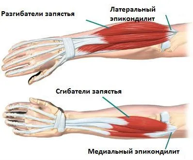 Tendinosis сухожилие на тазобедрената става, коляното и други стави, лечението