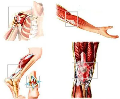 tendon Tendinoză de șold, genunchi și alte articulații, tratament