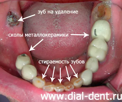 Teleszkópos protézis, a fogászati ​​implantátumok alternatív