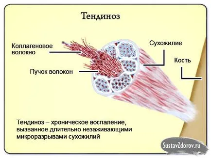 Tendinosis mi ez, okai, tünetei, diagnózis és kezelés