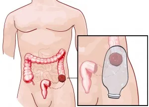 Ștergerea unei colostomie, toate stomă