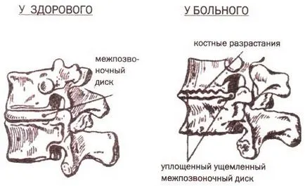 Injekciók Osteochondrosis kezelésre hatásos injekciók