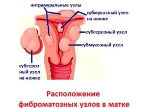 uterin nodular fibroamelor ceea ce este, o formă de tratament și a simptomelor