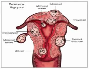 uterin nodular fibroamelor ceea ce este, o formă de tratament și a simptomelor