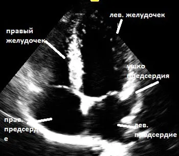 ecocardiografie cu ultrasunete a inimii