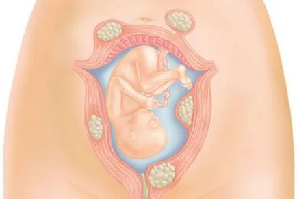 fibrom uterin nodulare tipuri, simptome, diagnostic, tratament, complicatii, fibroame la