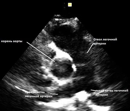 ecocardiografie cu ultrasunete a inimii