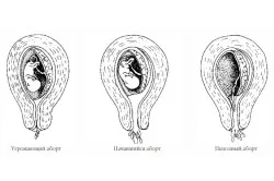 Спонтанният аборт в напреднала бременност причини