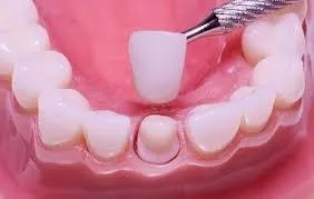Това спаси - зъб или корона отговори на основните въпроси, свързани с лечение на зъбите под короната