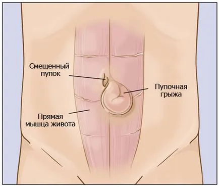 Конспирация херния за деца и възрастни - до пъпа и гръбначния стълб