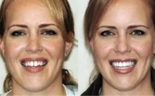 Zoom Albirea dinților - professonalnaya acasă și recenzii proceduri
