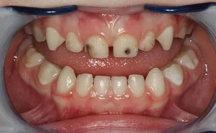 Зъбобол при деца, как да се премахне дете зъбобол
