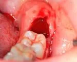 Алвеолит след изваждане на зъб причини, симптомите и лечението